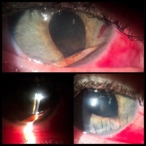 Penetrating trauma of the cornea (1)